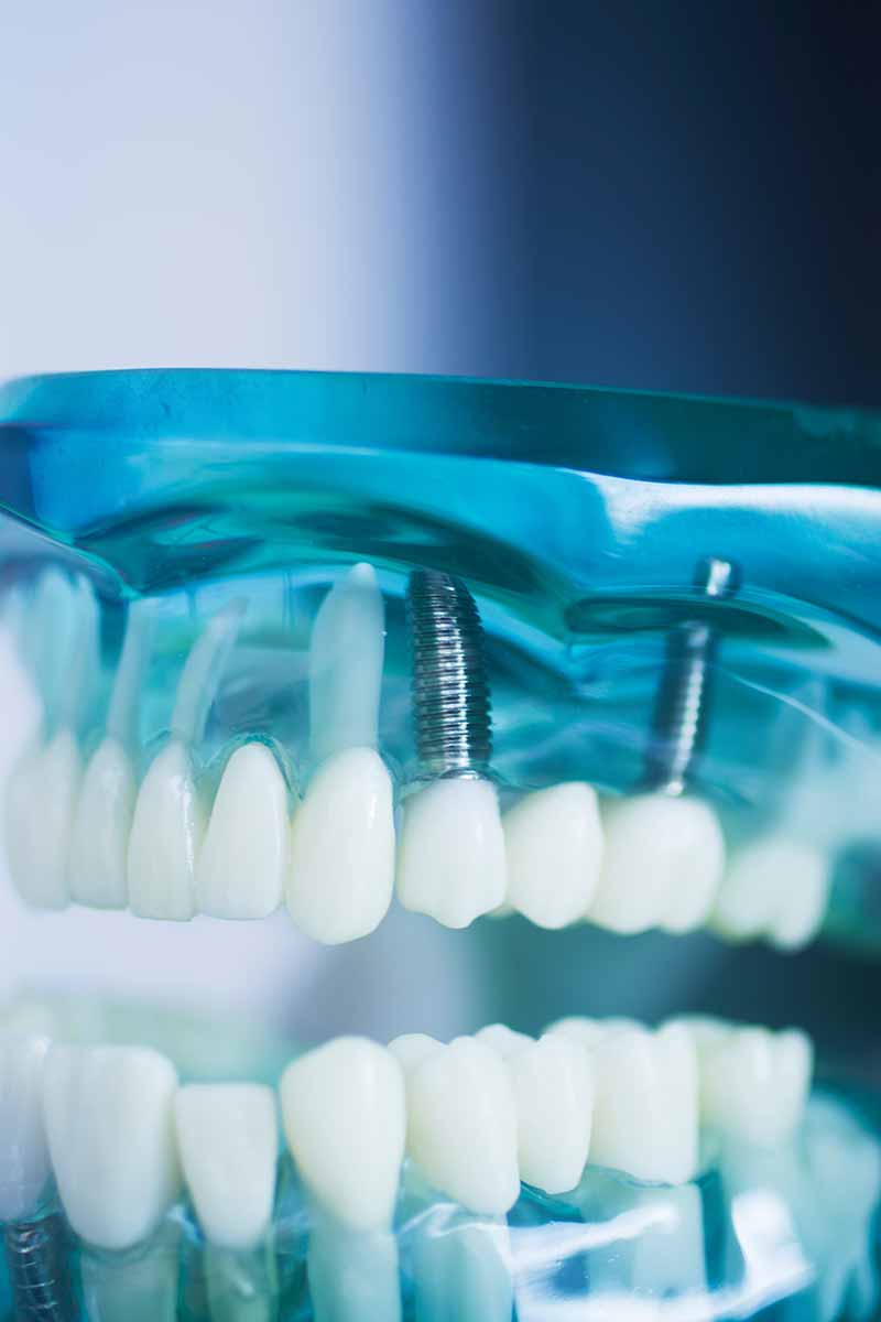 Implantat vom Zahnarzt in Schwaz
